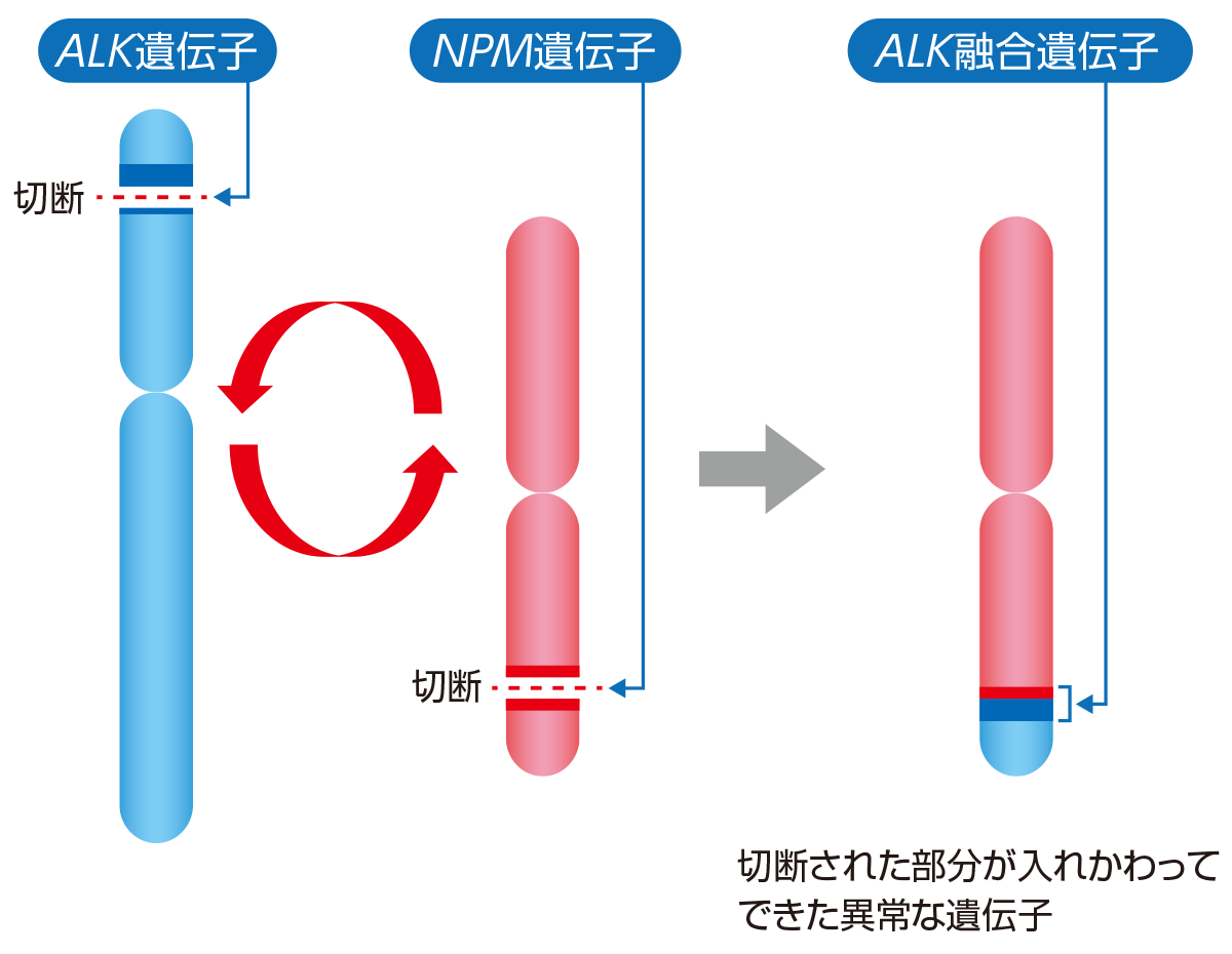 ALK遺伝子がNPM4遺伝子などと融合してALK融合遺伝子が発現します。融合の際に切断された部分が入れかわってできた異常な遺伝子がALK融合遺伝子です。
