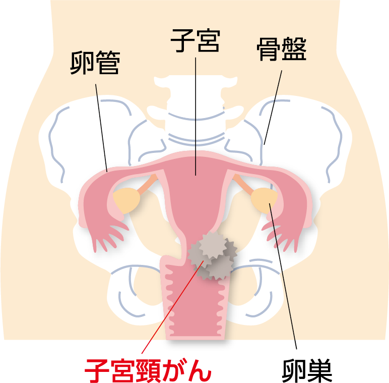 子宮の入り口の子宮頸部と呼ばれる部分から発生するがんを子宮頸がんといいます。