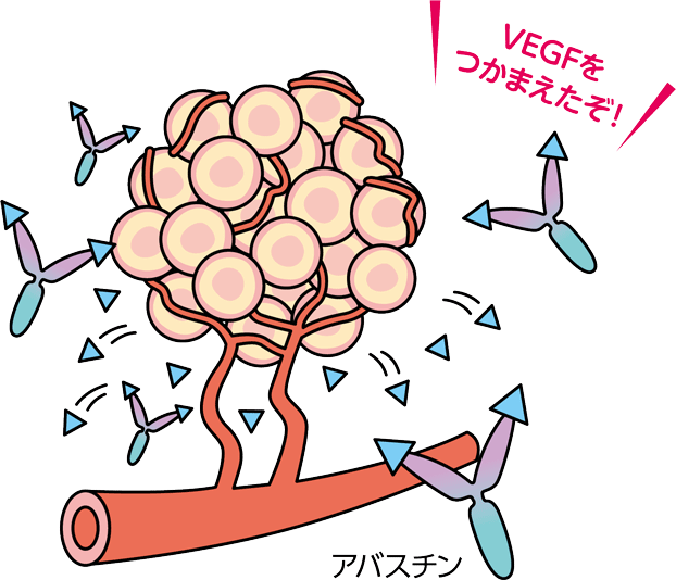 アバスチンがVEGFをつかまえることで血管新生を抑え、腫瘍を縮小する様子を示すイラスト